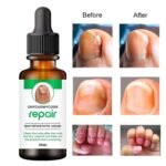 Nail serum for nail repair, fungal infection, anti-infective removal| 100% Natural Profesional 30 ML Serum For Nail Strong| Supple and Shaped Nail Care Serum |30ML pack of 1|